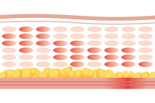 hifu procedure