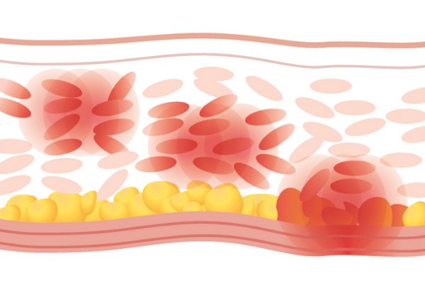 hifu procedure