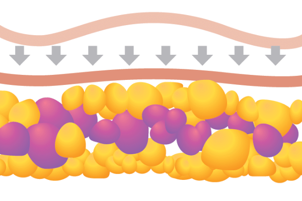 HIFU body shaping procedure