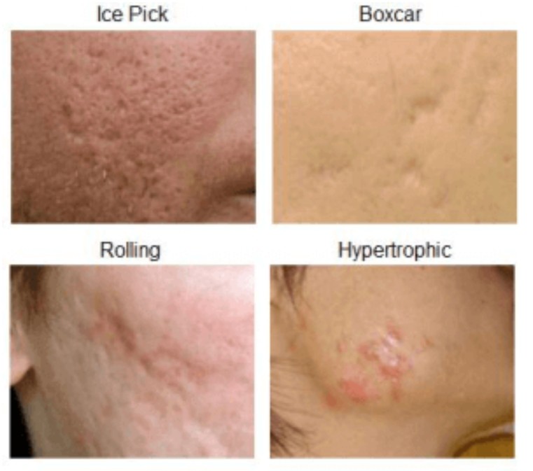 acne scar treatment singapore