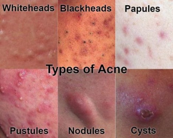 active acne types