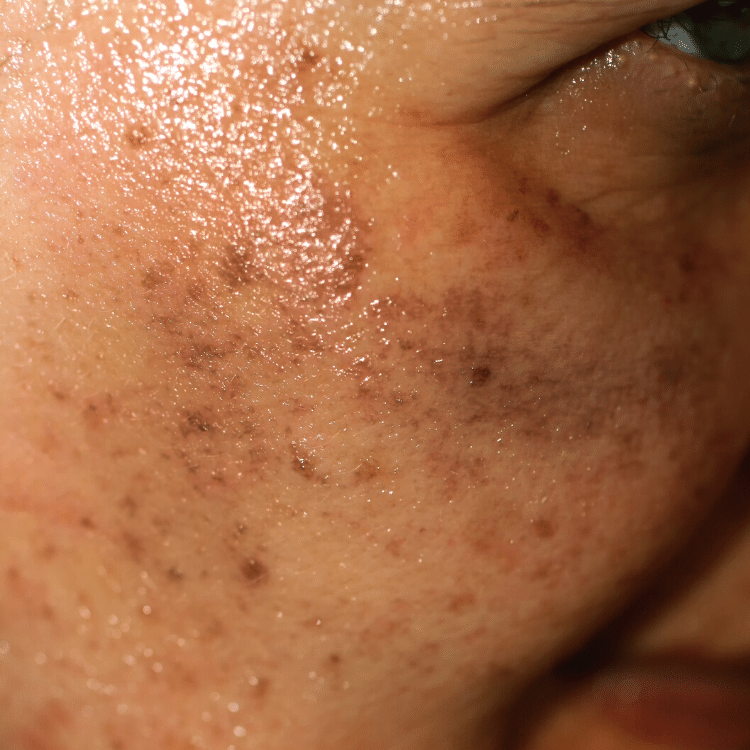 hori's nevus pigmentation