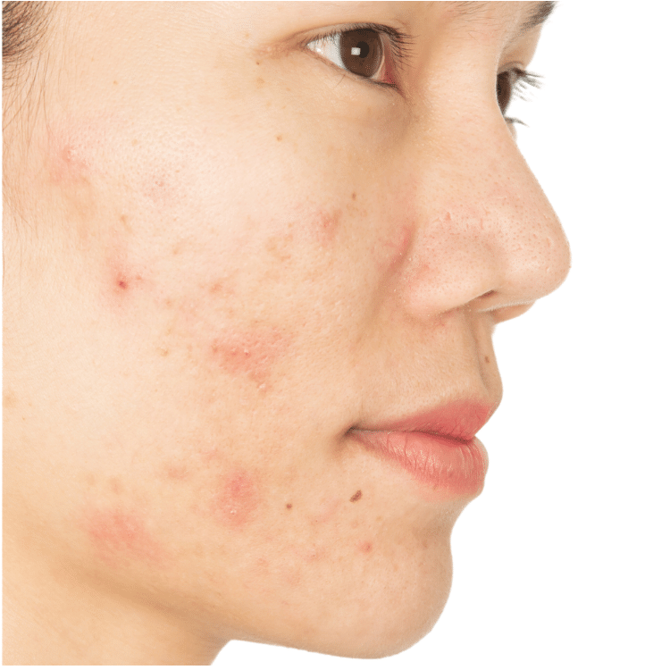 post-inflammatory hyperpigmentation