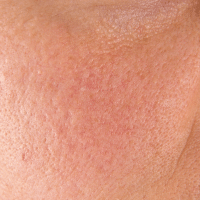 Uneven skin texture
