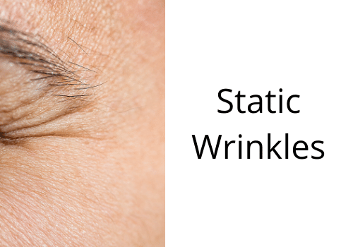 static wrinkles