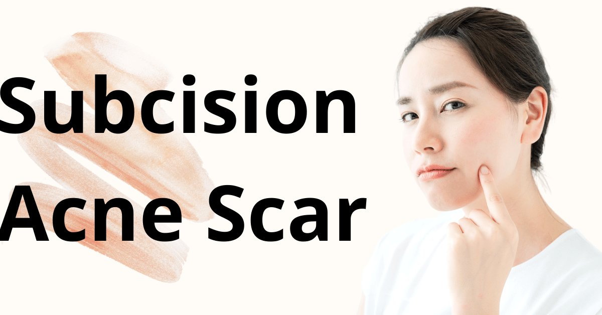 Subcision Acne Scar Singapore