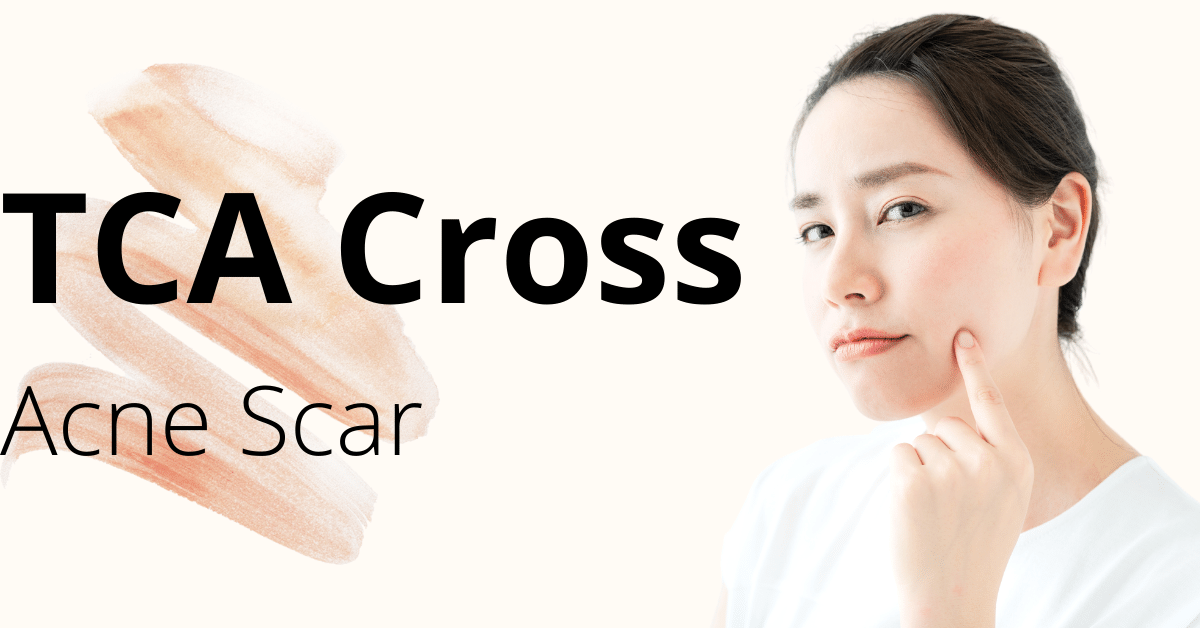 TCA cross acne scar singapore