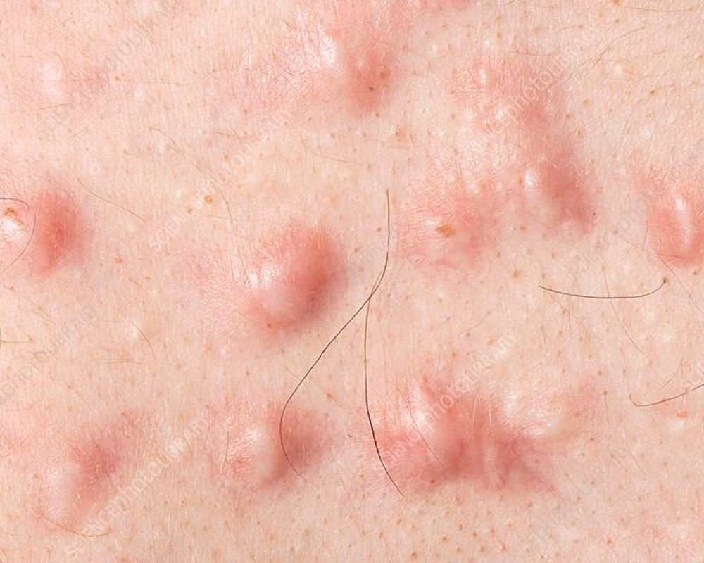 Keloid Acne Scars Singapore