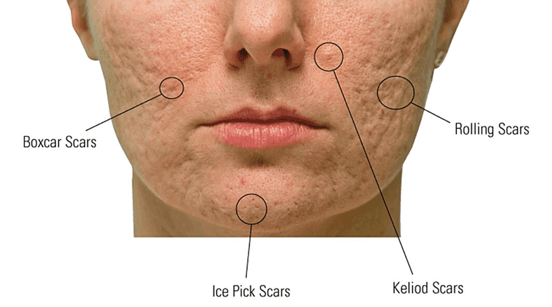 TYPE OF ACNE SCARS