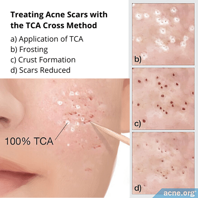 tca cross acne treatment singapore
