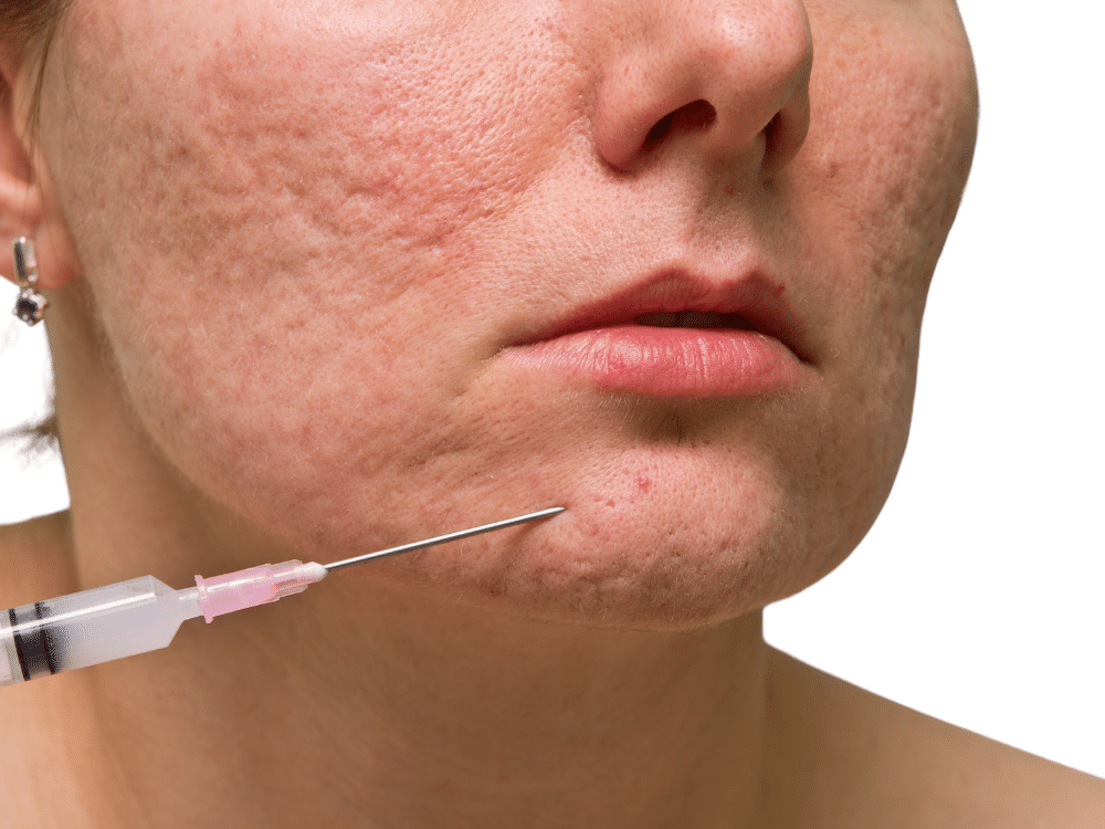 subcision acne scar treatment singapore